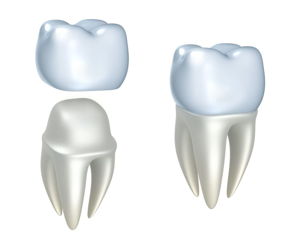 How to Fix a Damaged Dental Crown